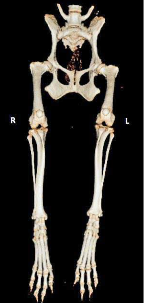 AXON COMUNICACION, Osteotomía femoral distal para el tratamiento de la retroversión femoral
