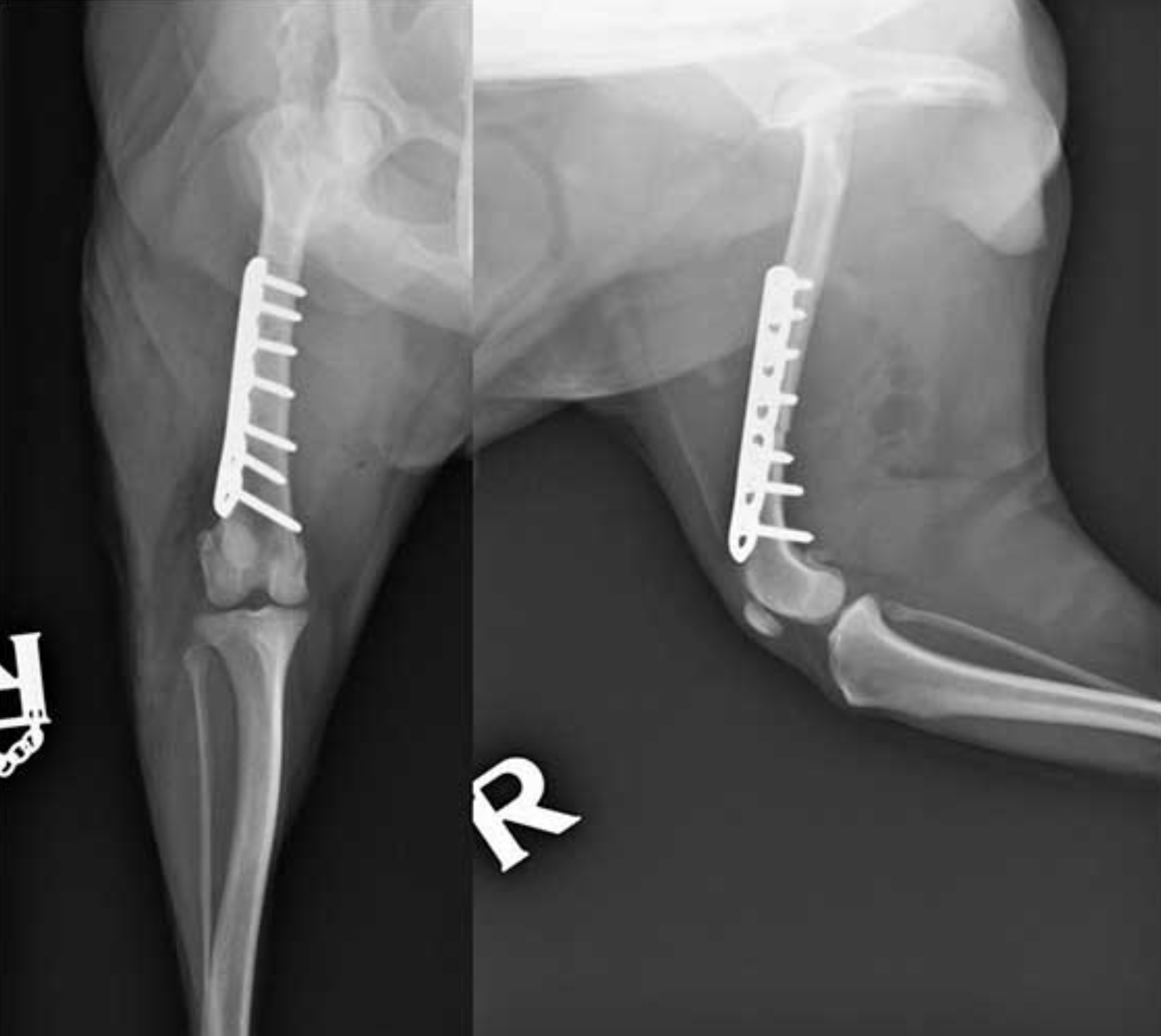 AXON COMUNICACION,Osteotomía femoral distal para el tratamiento de la retroversión femoral