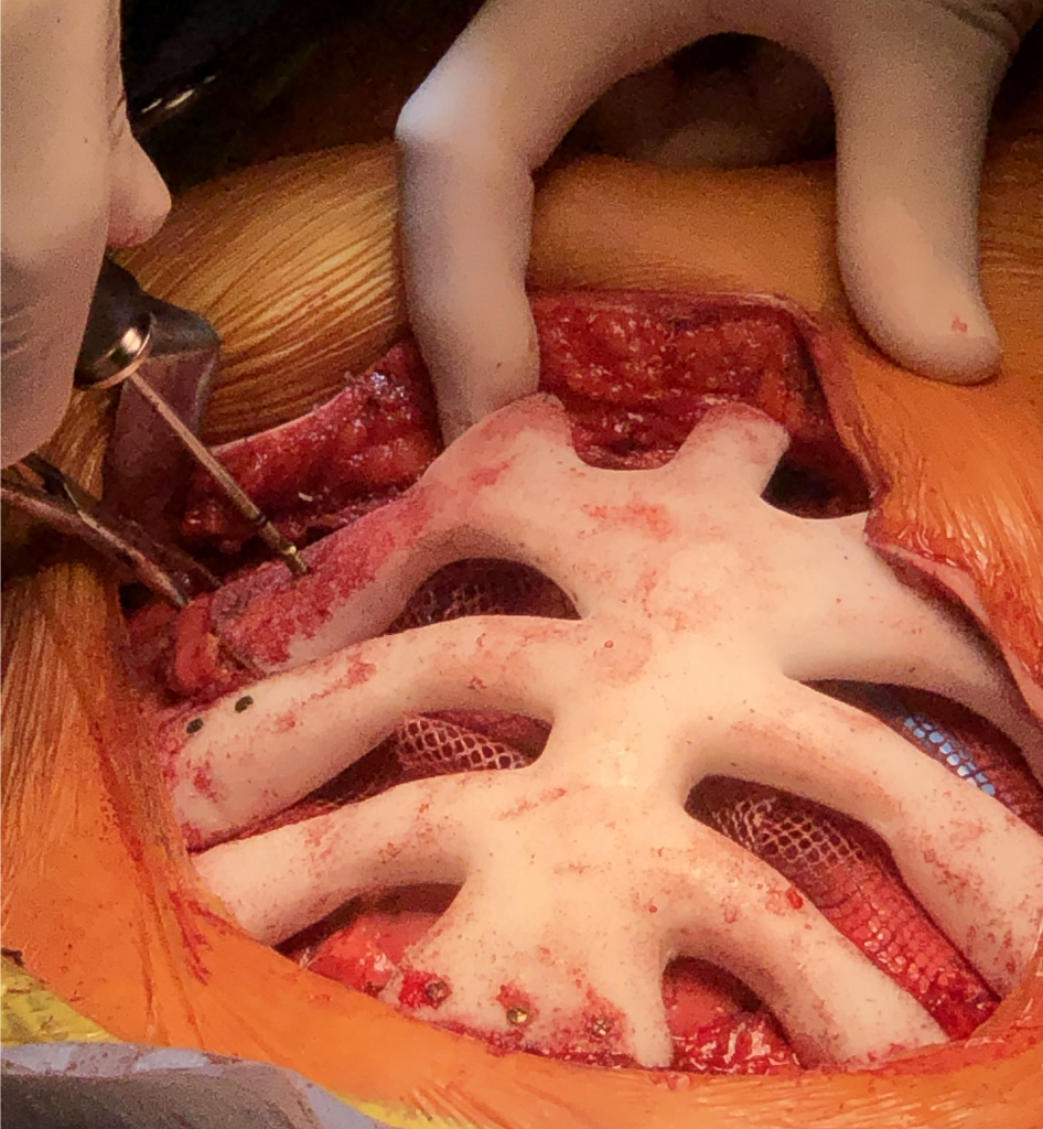 El increíble primer implante de caja torácica del mundo cobra vida