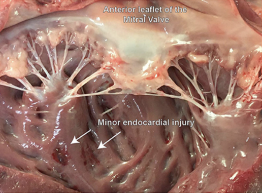 Qué hacer y qué no hacer en modelos animales grandes de insuficiencia aórtica, foto Legión leve lesión en la superficie endocárdica del ventrículo izquierdo