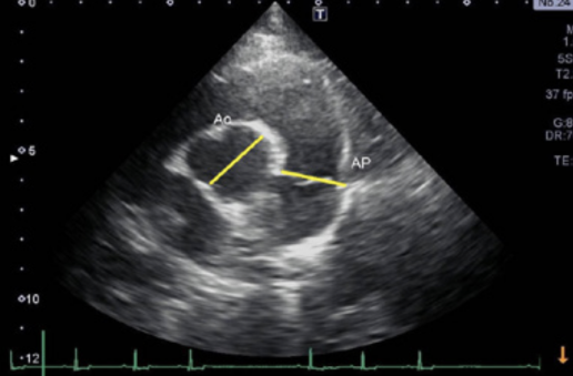 ¿Cómo valoramos ecocardiográficamente el ventrículo derecho?