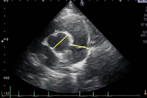 ¿Cómo valoramos ecocardiográficamente el ventrículo derecho?