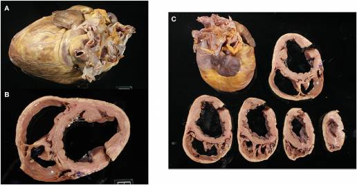 Historia natural de los cambios histopatológicos en la miocardiopatía de la distrofia muscular del Golden Retriever