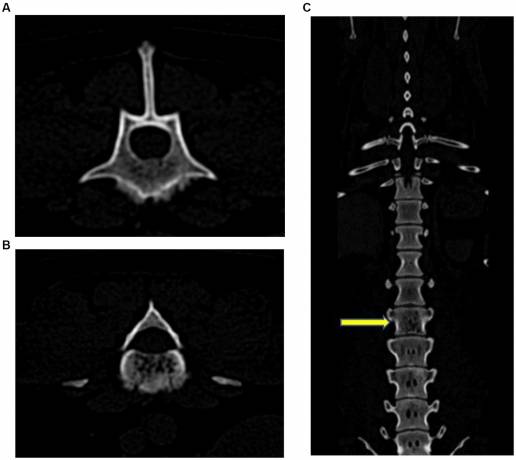 Caso clínico: Corpectomía y autoinjerto óseo de cresta ilíaca como tratamiento de un tumor de células plasmáticas vertebrales en un perro salchicha