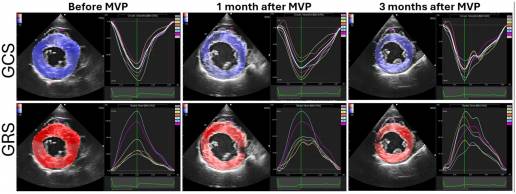Ecocardiografía de seguimiento moteado para la evaluación de las funciones miocárdicas antes y después de la valvuloplastia mitral en perros