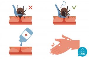 La Fundación SOS Lyme alerta sobre los "peligrosos" métodos para extraer garrapatas publicados en Internet