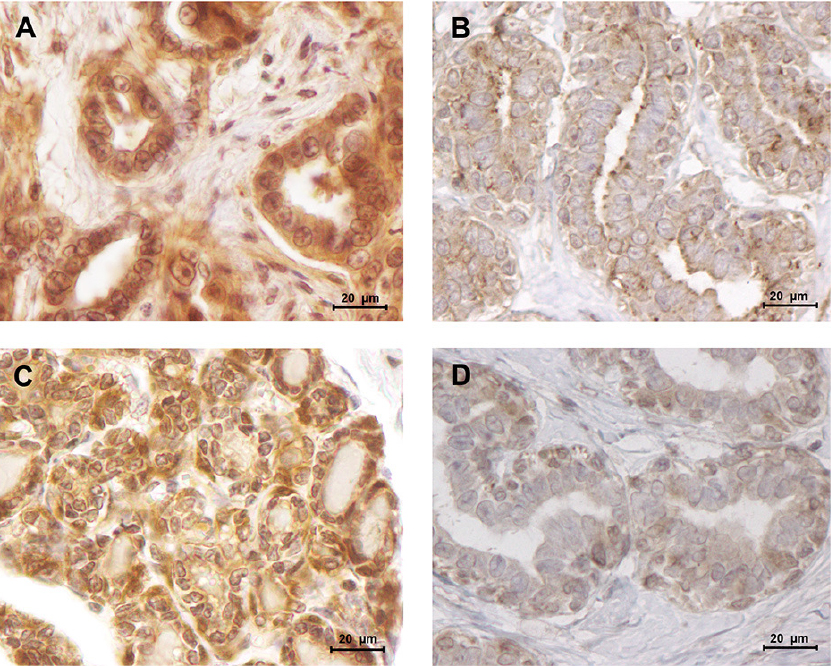 Obesity is an established risk factor for breast cancer in post-menopausal women, being associated with elevated serum levels of leptin.