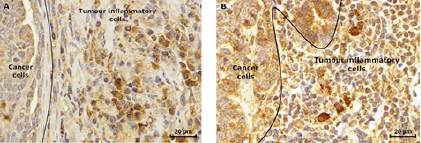 Obesity is an established risk factor for breast cancer in post-menopausal women, being associated with elevated serum levels of leptin.