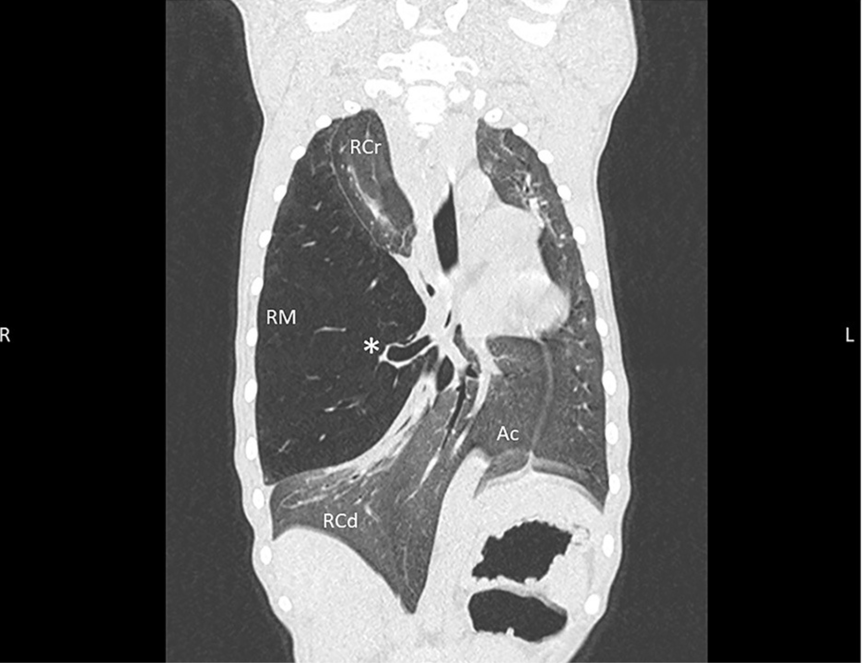 Edwards LM, Lux CN, Everett M and Hecht S (2023) Case report: Treatment of congenital lobar emphysema with lung lobectomy in a puppy. Front. Vet. Sci. 10:1083376. doi: 10.3389/fvets.2023.1083376
