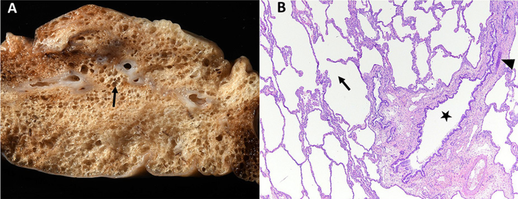 Edwards LM, Lux CN, Everett M and Hecht S (2023) Case report: Treatment of congenital lobar emphysema with lung lobectomy in a puppy. Front. Vet. Sci. 10:1083376. doi: 10.3389/fvets.2023.1083376