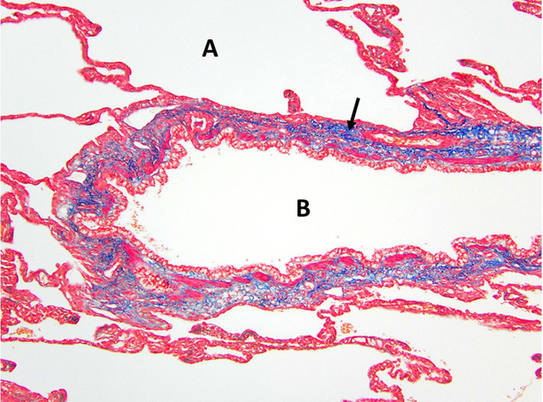 Edwards LM, Lux CN, Everett M and Hecht S (2023) Case report: Treatment of congenital lobar emphysema with lung lobectomy in a puppy. Front. Vet. Sci. 10:1083376. doi: 10.3389/fvets.2023.1083376