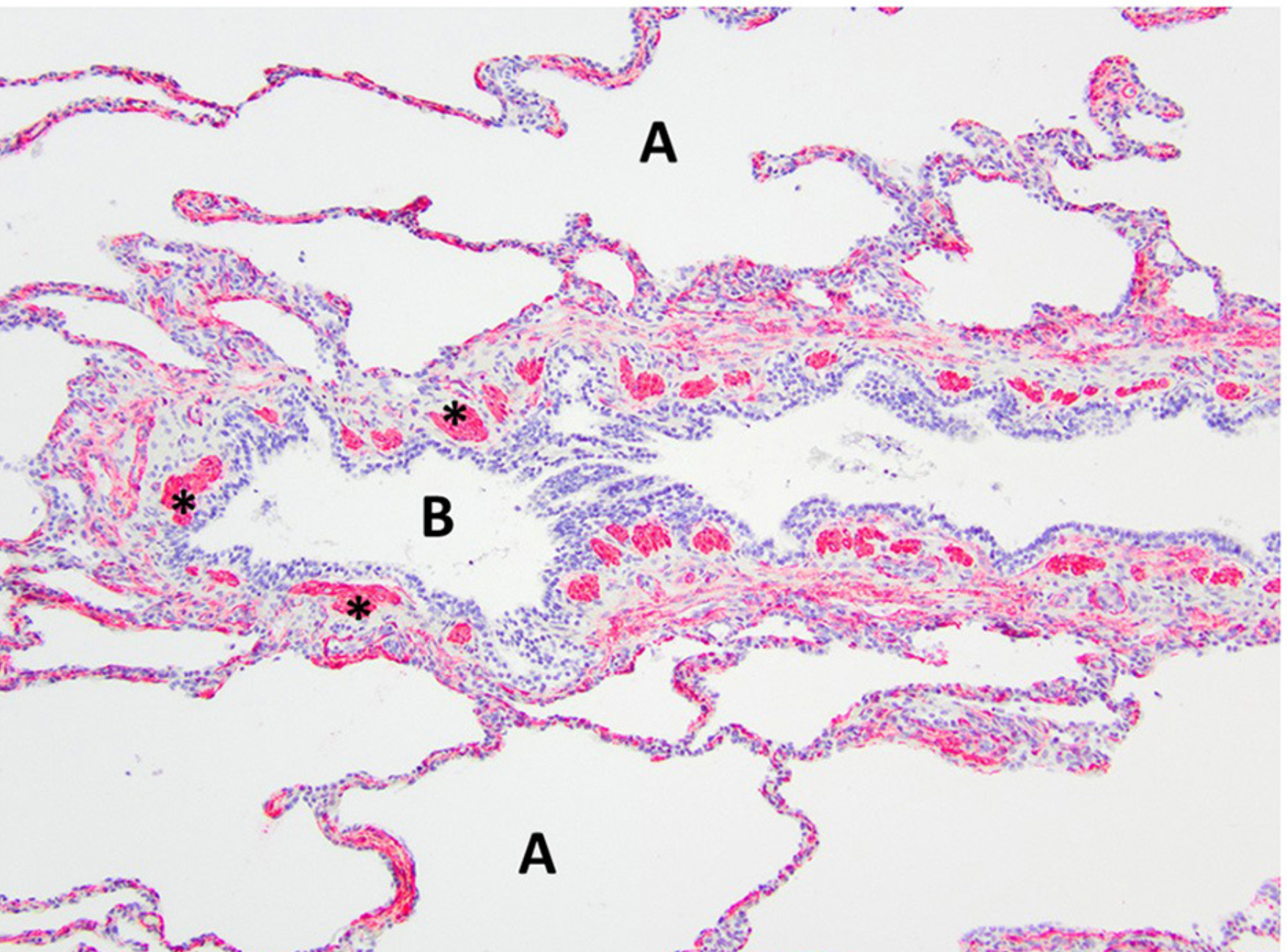 Edwards LM, Lux CN, Everett M and Hecht S (2023) Case report: Treatment of congenital lobar emphysema with lung lobectomy in a puppy. Front. Vet. Sci. 10:1083376. doi: 10.3389/fvets.2023.1083376